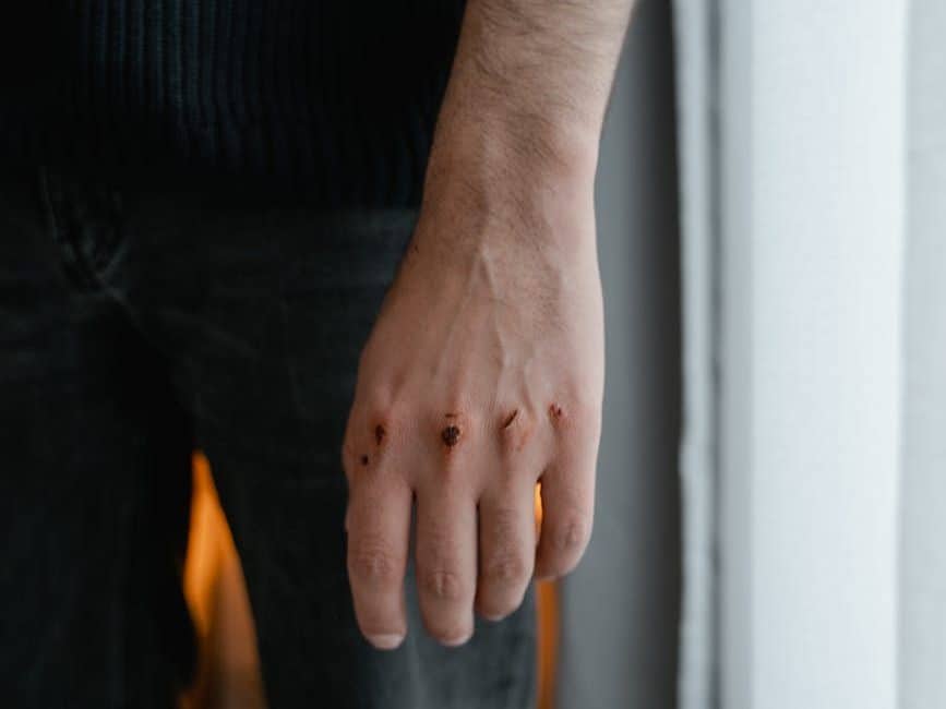 close up shot of wound on a person s hand