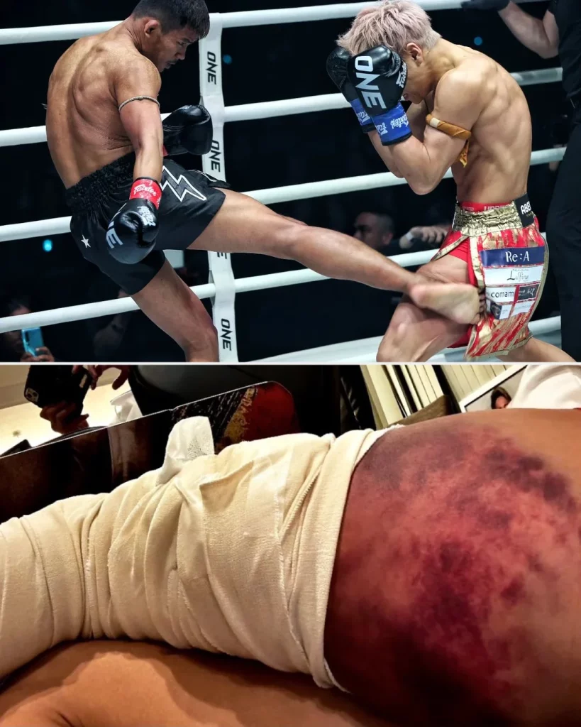 kickboxer with bruised leg after fight